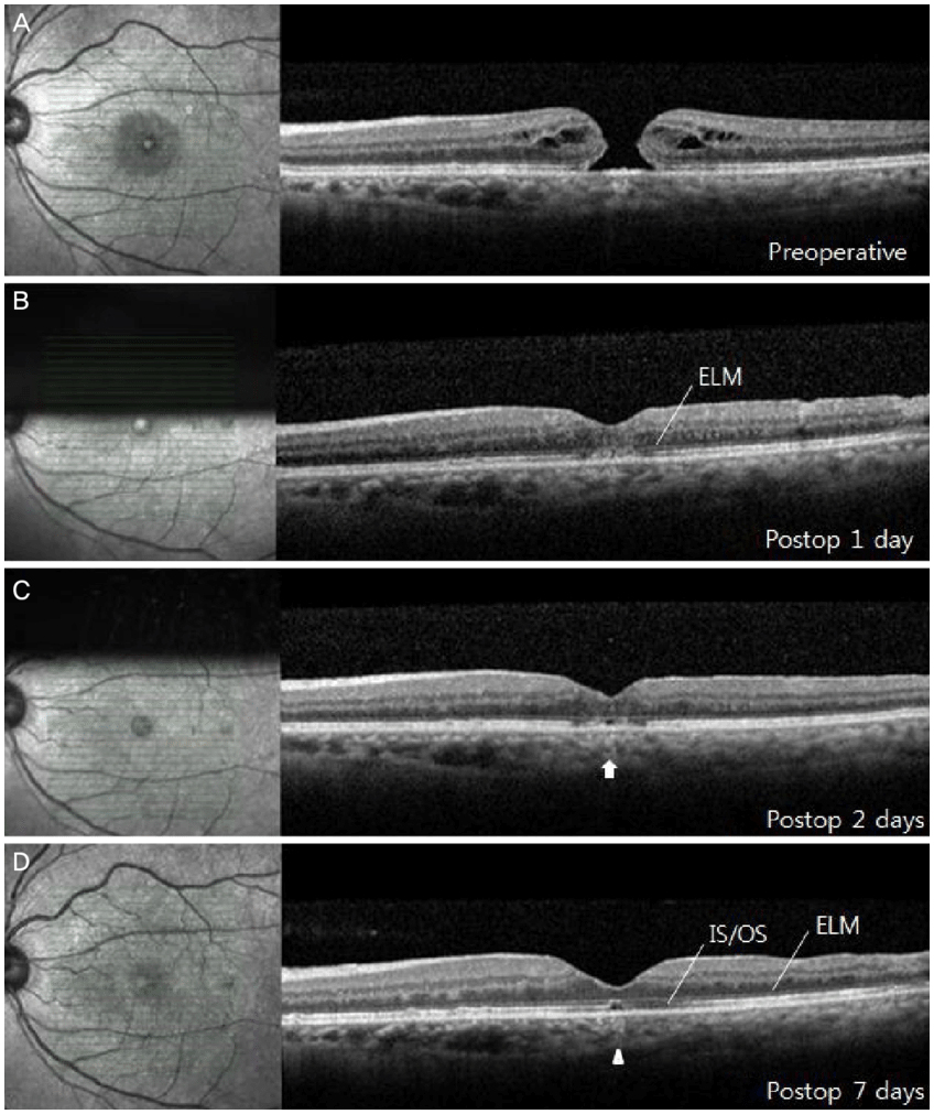 Agujero Macular